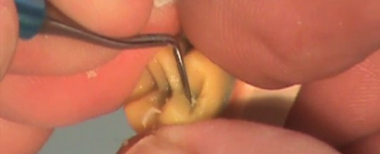 Crown and Bridge Full Cast Waxing Demo